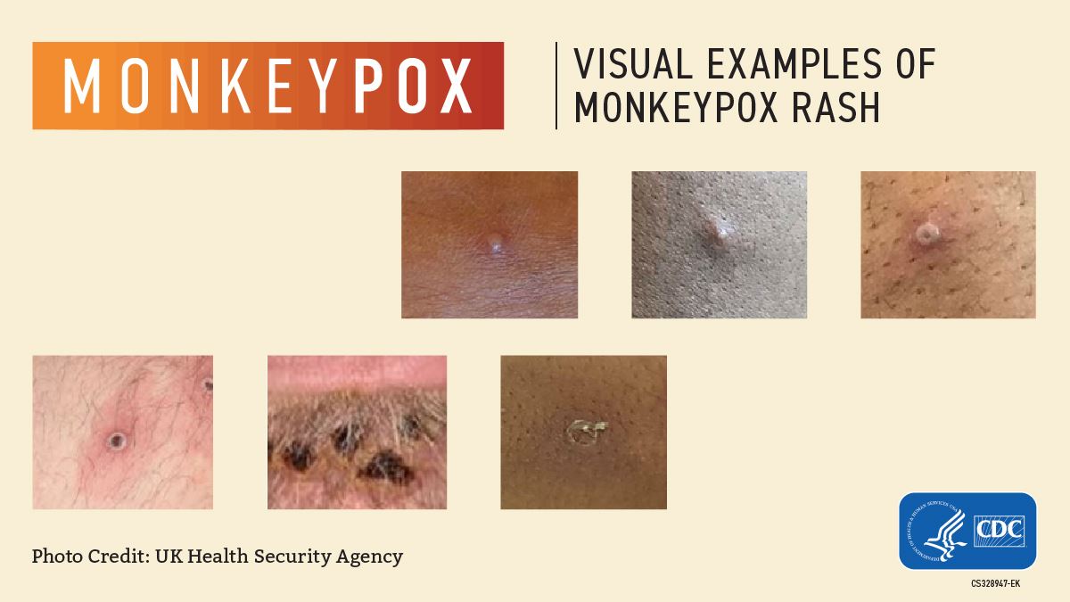 Pictures of monkeypox rash